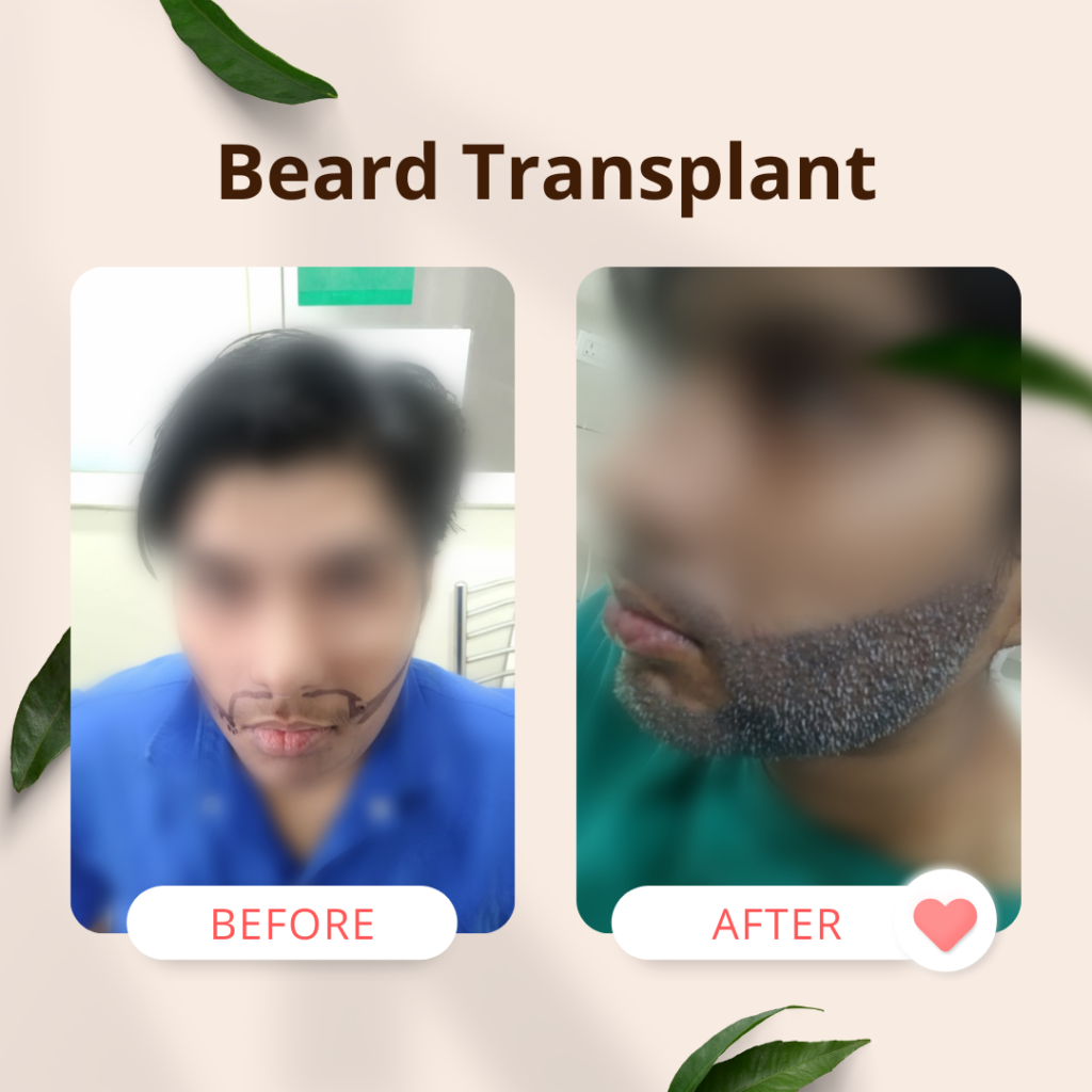 beard transplant in india 