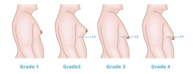stages of gynecomastia